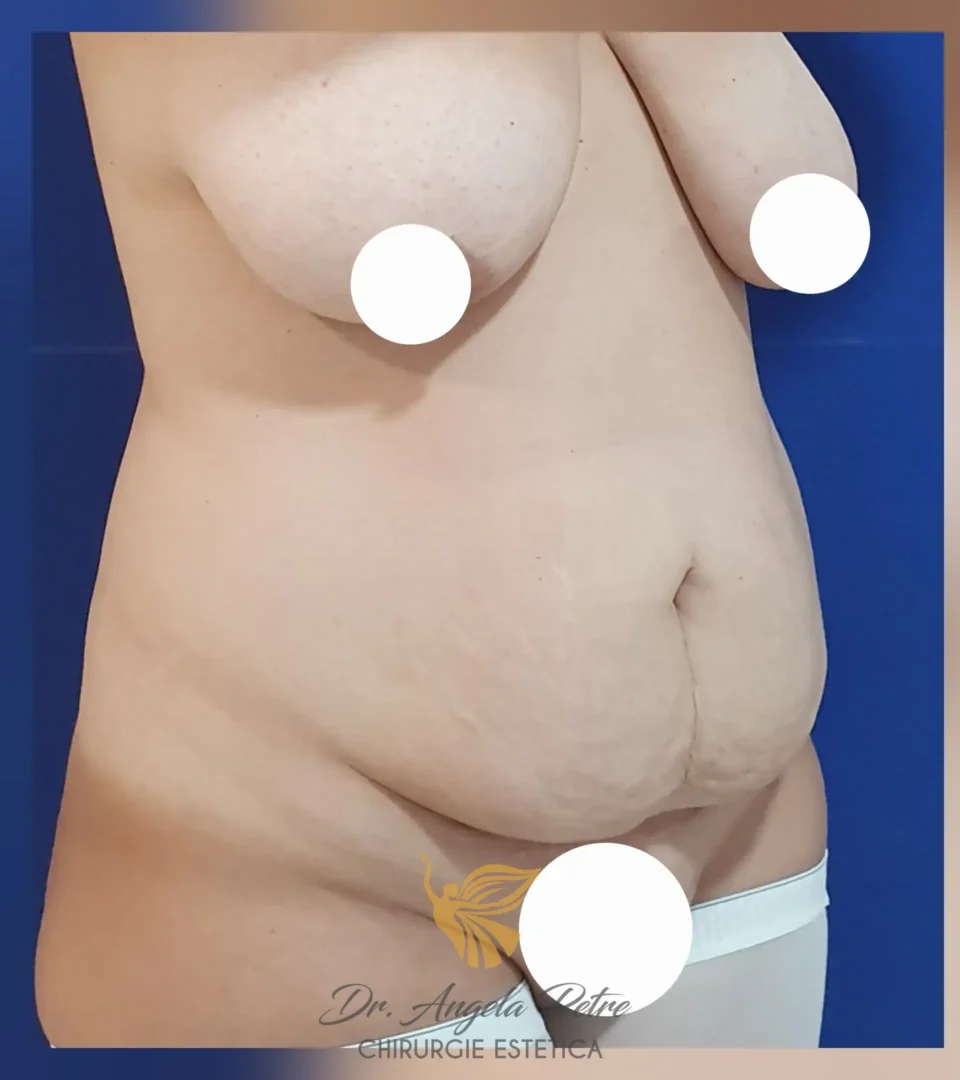 Caz 01 Abdominoplastie, semiprofil, before, Dr. Angela Petre - București