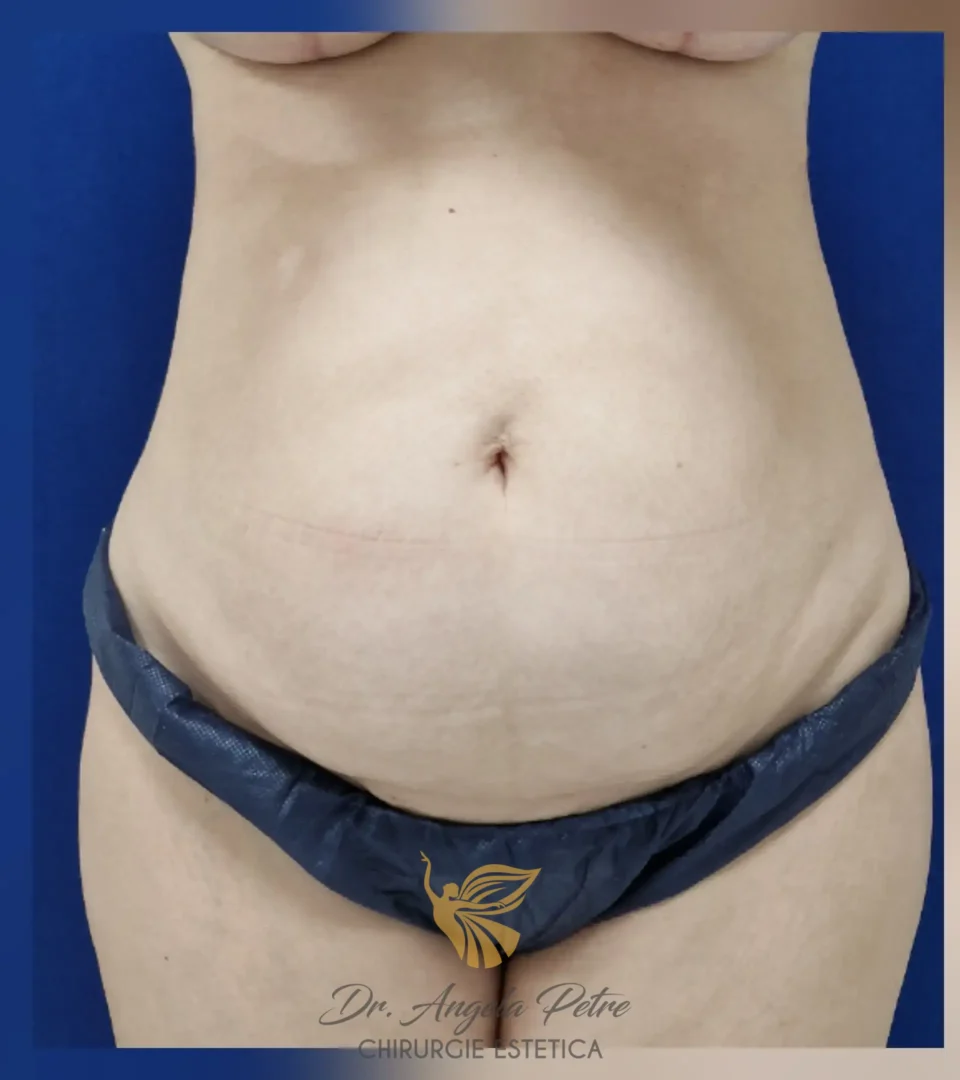 Caz 02 Abdominoplastie, frontal, before, Dr. Angela Petre - București