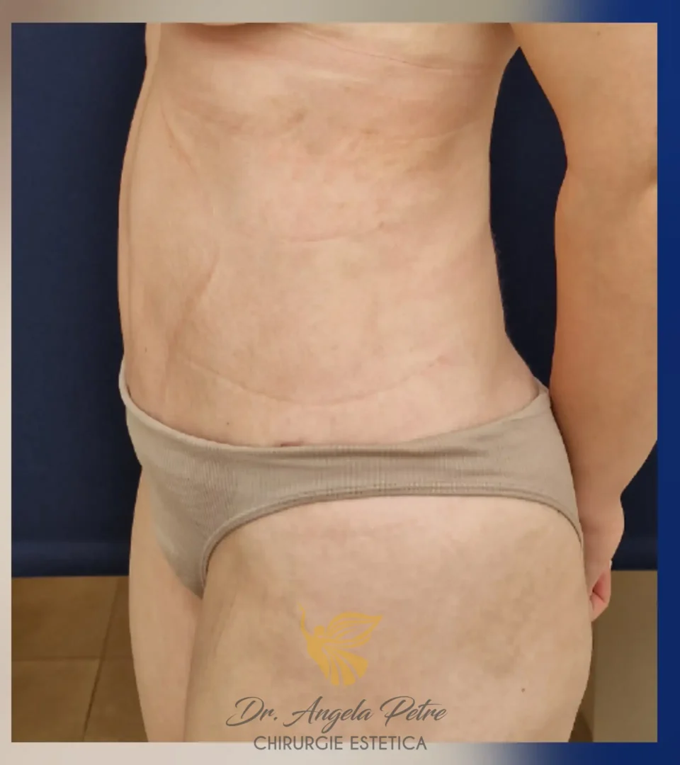 Caz 02 Abdominoplastie, profil, after, Dr. Angela Petre - București