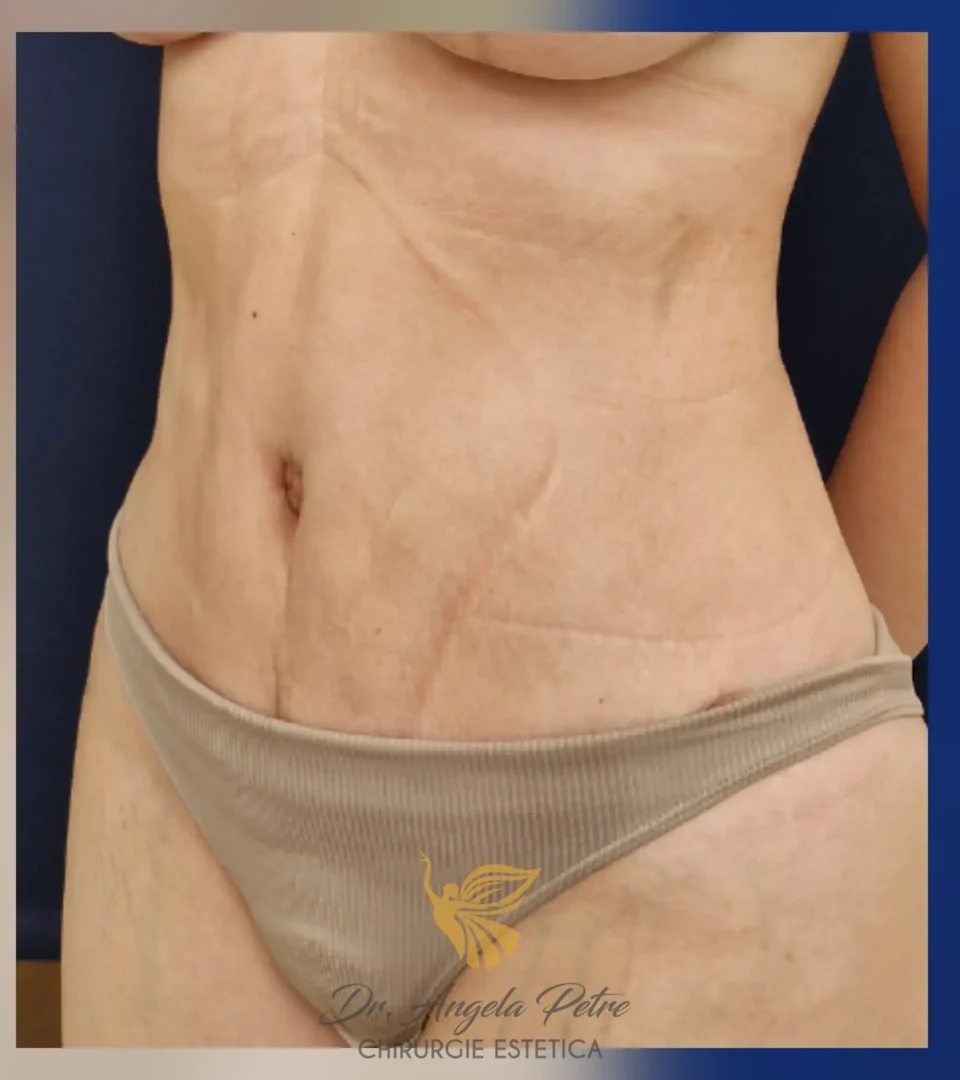 Caz 02 Abdominoplastie, semiprofil, after, Dr. Angela Petre - București
