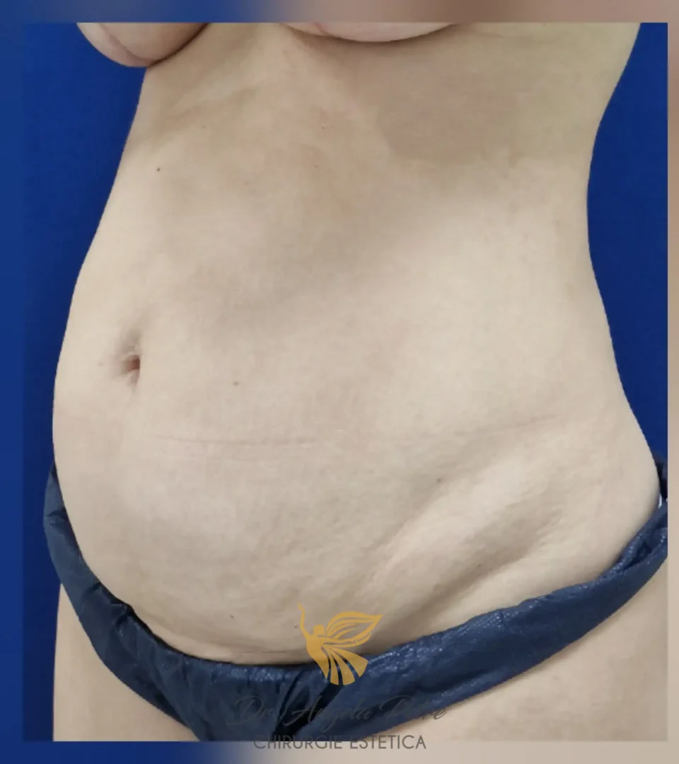 Caz 02 Abdominoplastie, semiprofil, before, Dr. Angela Petre - București
