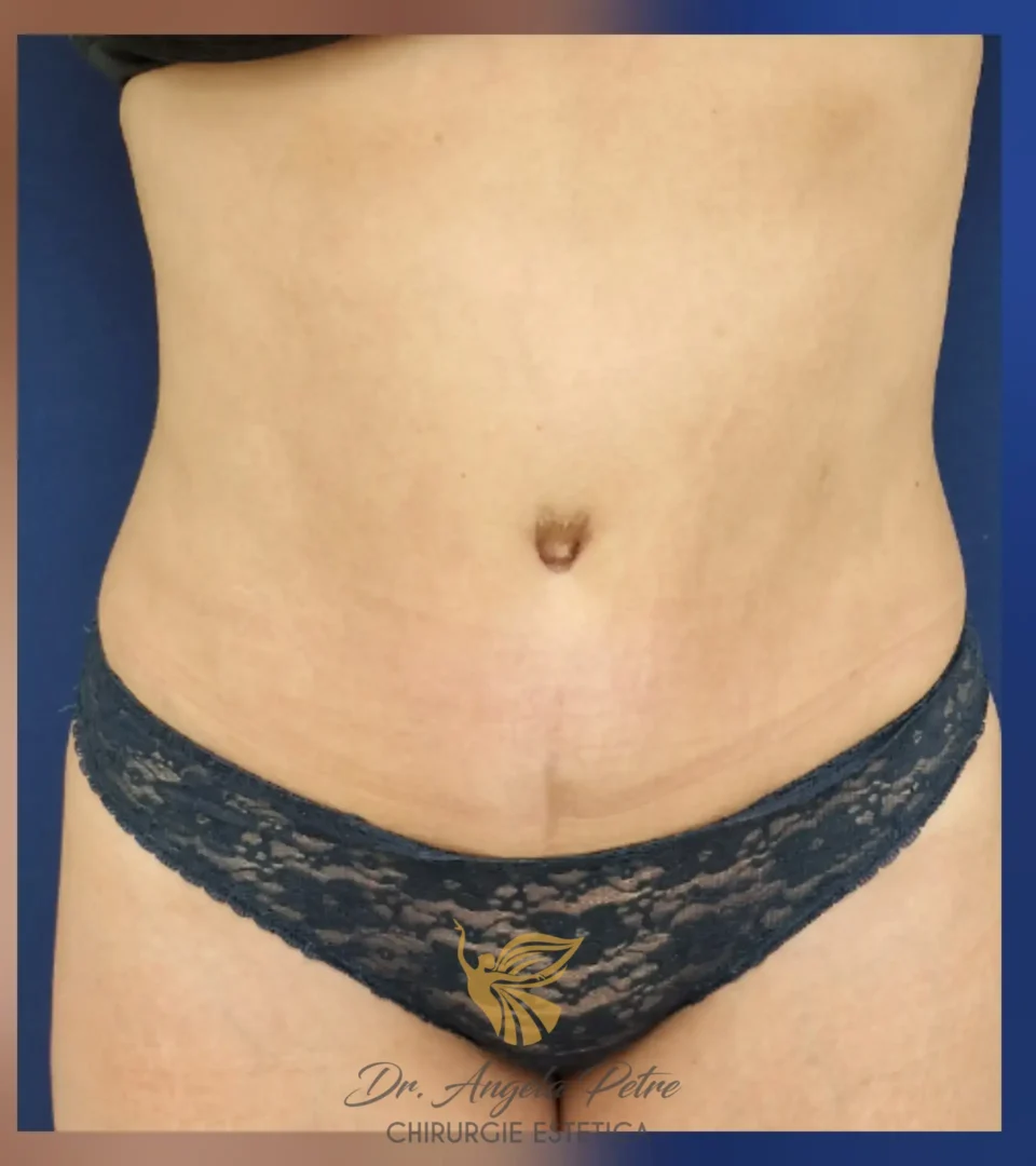 Caz 03 Abdominoplastie, frontal, after, Dr. Angela Petre - București