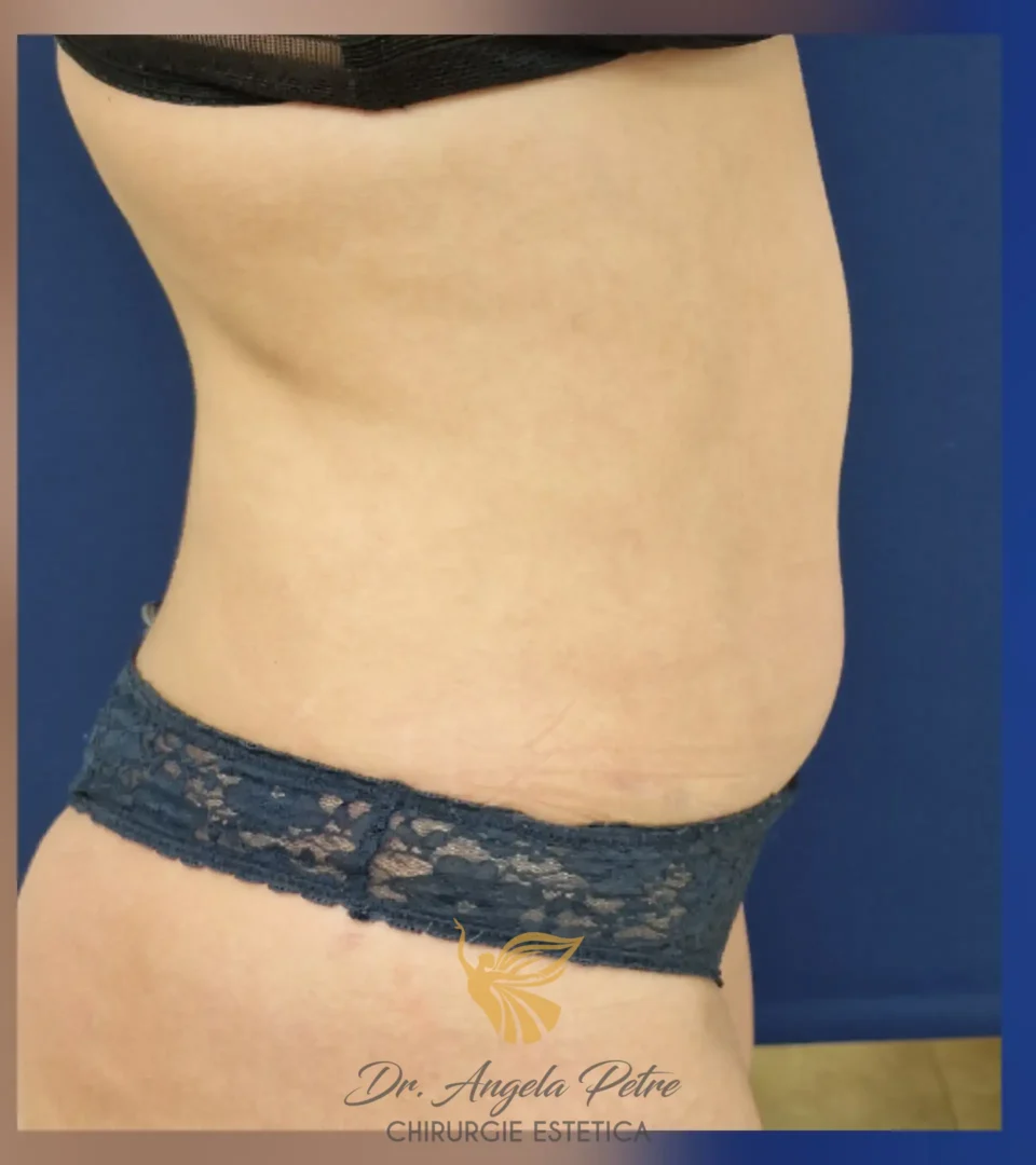 Caz 03 Abdominoplastie, profil, after, Dr. Angela Petre - București