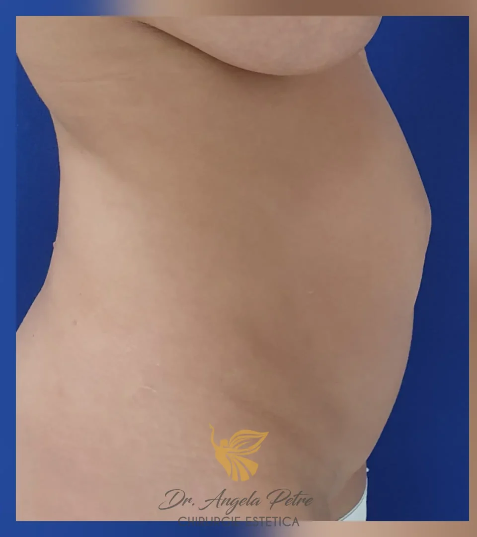 Caz 03 Abdominoplastie, profil, before, Dr. Angela Petre - București