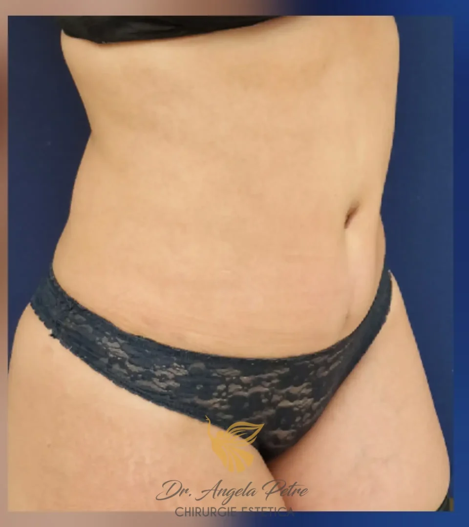 Caz 03 Abdominoplastie, semiprofil, after, Dr. Angela Petre - București