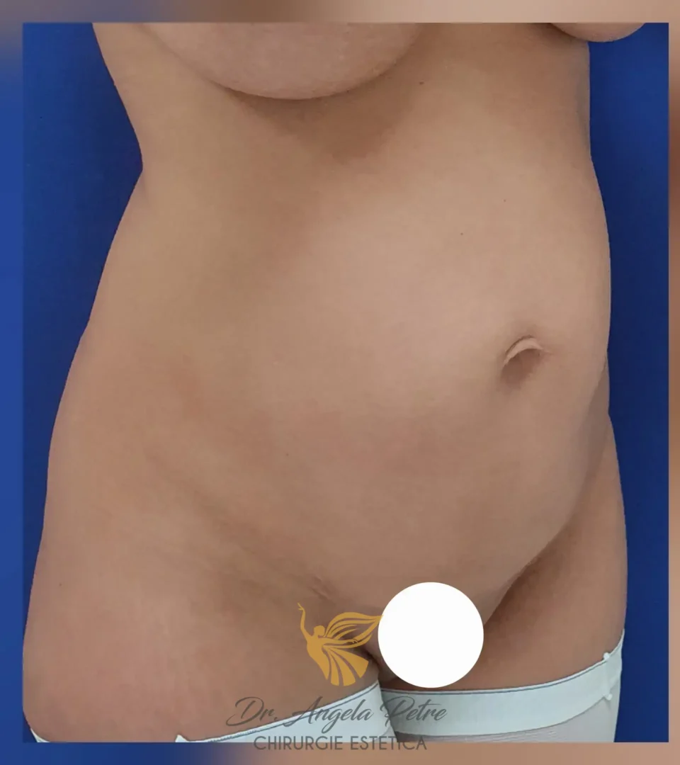 Caz 03 Abdominoplastie, semiprofil, before, Dr. Angela Petre - București