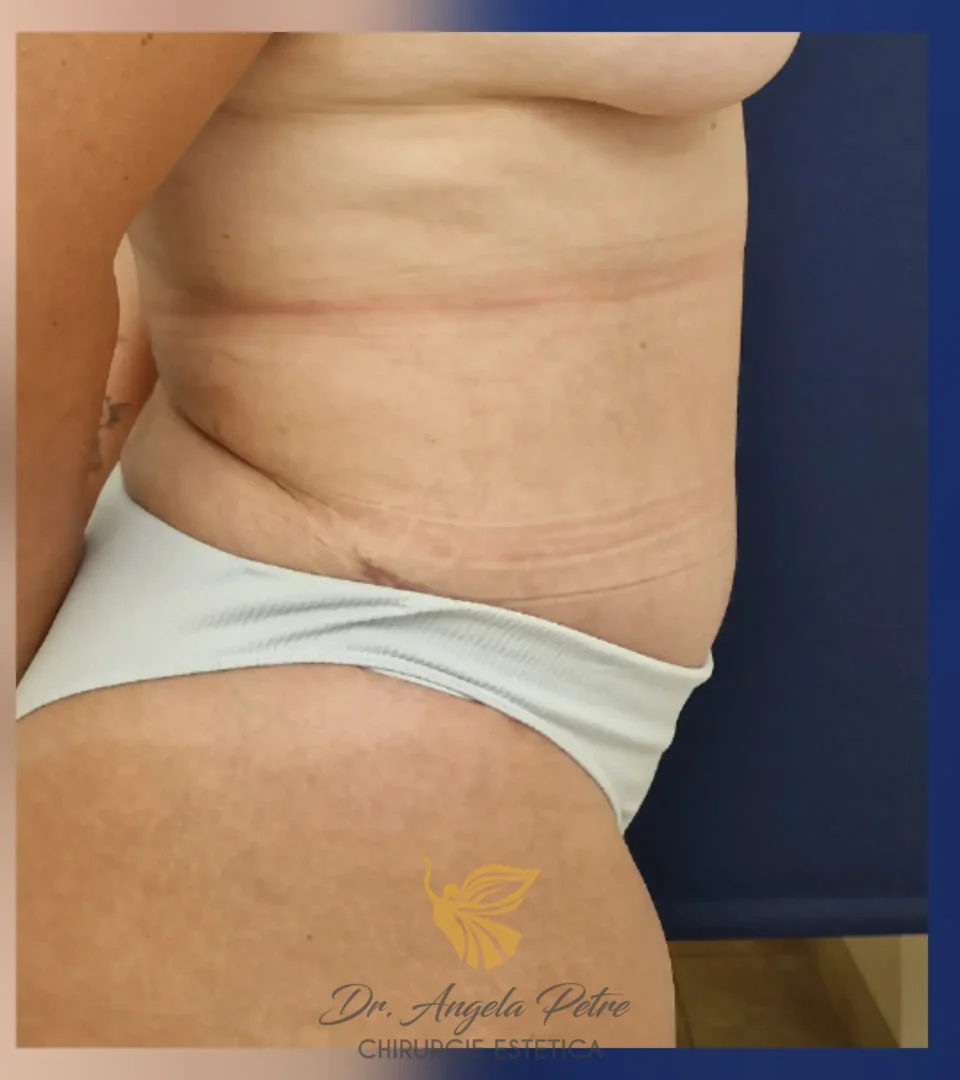 Caz 04 Abdominoplastie, profil, after, Dr. Angela Petre - București