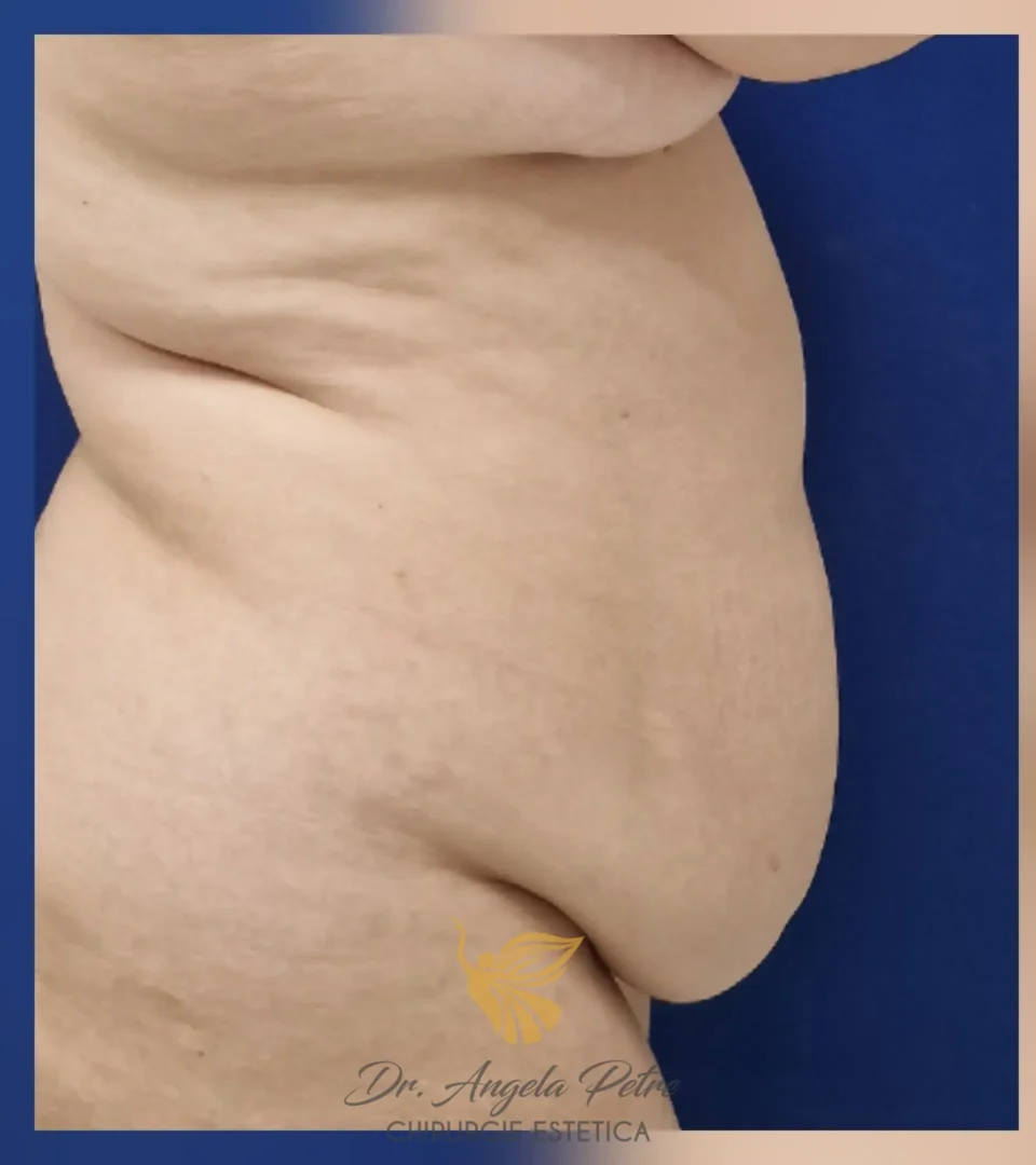 Caz 04 Abdominoplastie, profil, before, Dr. Angela Petre - București