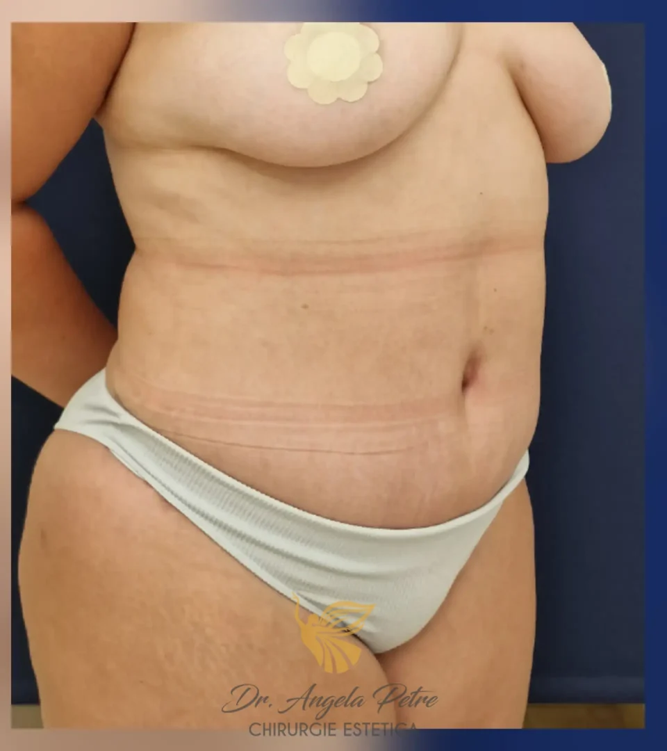 Caz 04 Abdominoplastie, semiprofil, after, Dr. Angela Petre - București