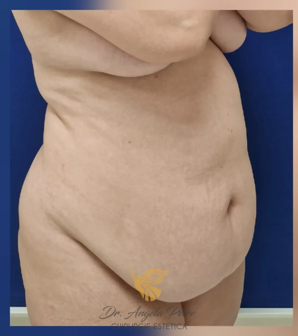 Caz 04 Abdominoplastie, semiprofil, before, Dr. Angela Petre - București