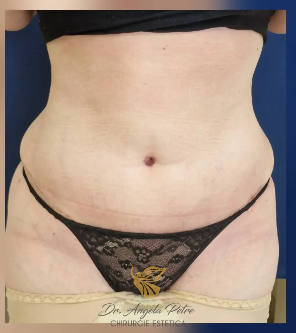 Caz 05 Abdominoplastie, frontal, after, Dr. Angela Petre - București