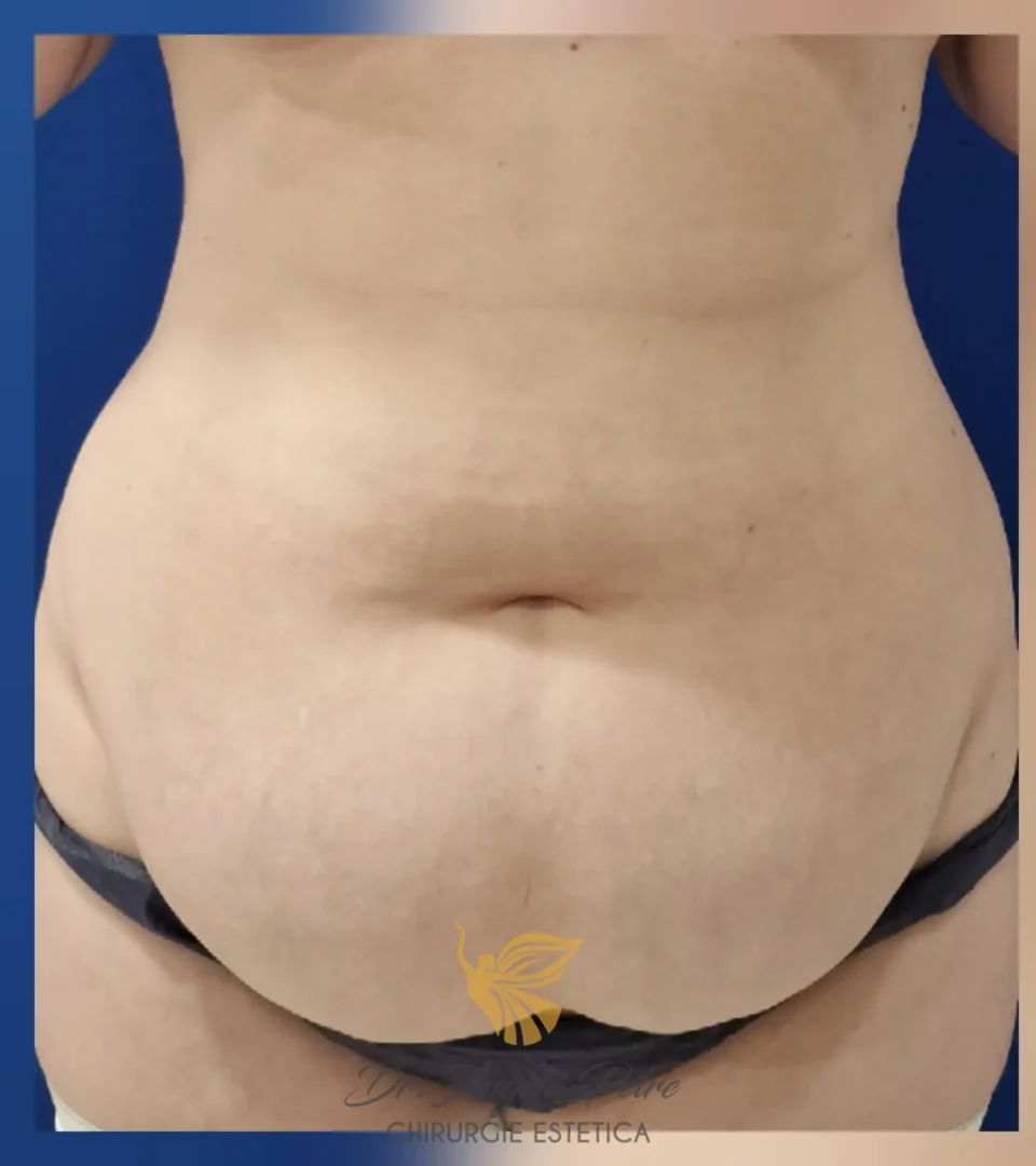 Caz 05 Abdominoplastie, frontal, before, Dr. Angela Petre - București