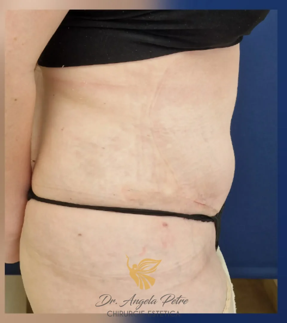 Caz 05 Abdominoplastie, profil, after, Dr. Angela Petre - București
