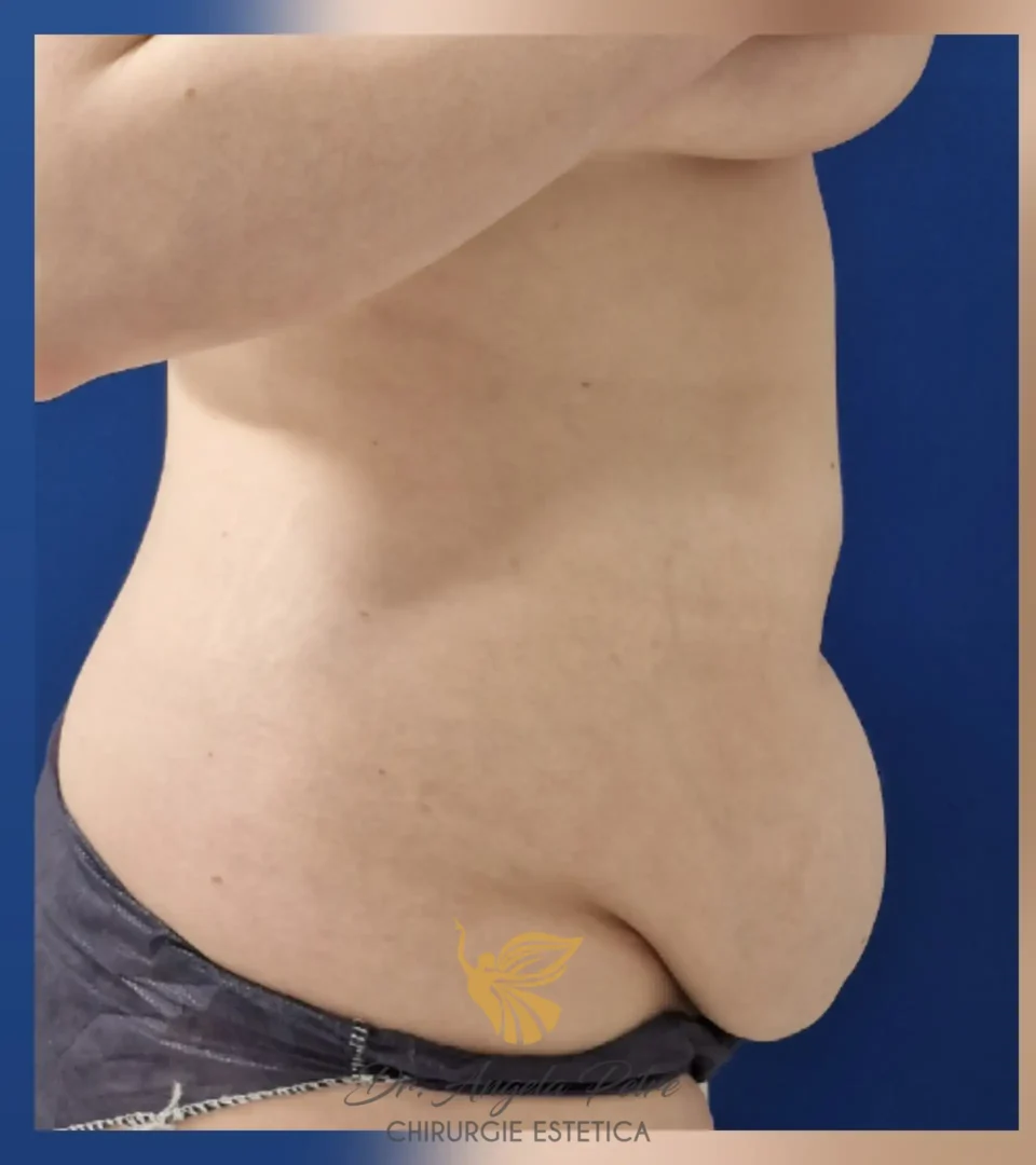 Caz 05 Abdominoplastie, profil, before, Dr. Angela Petre - București
