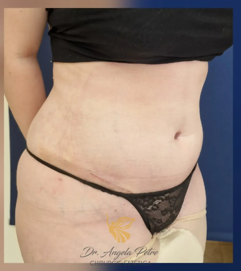 Caz 05 Abdominoplastie, semiprofil, after, Dr. Angela Petre - București