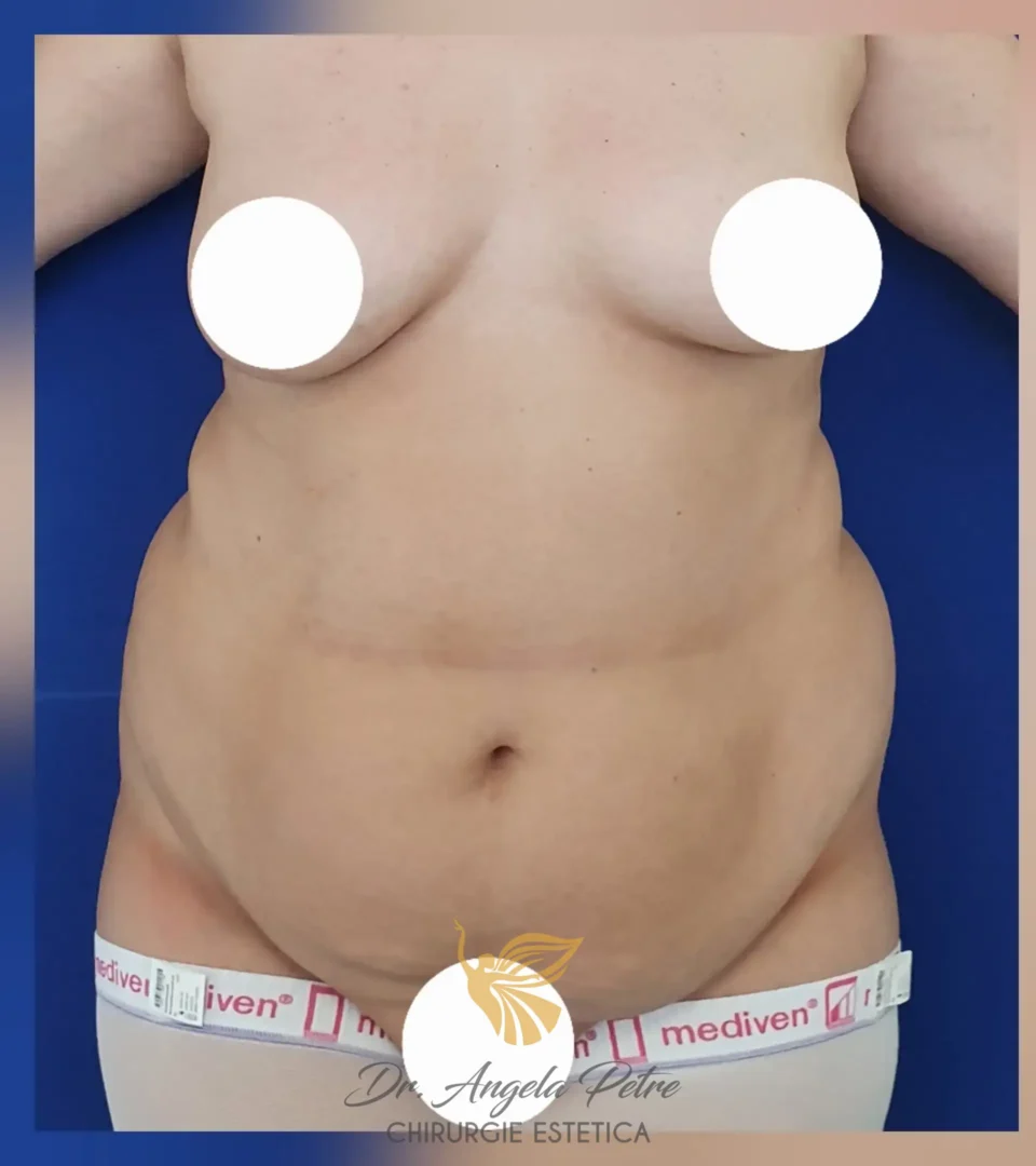 Caz 06 Abdominoplastie, frontal, before, Dr. Angela Petre - București