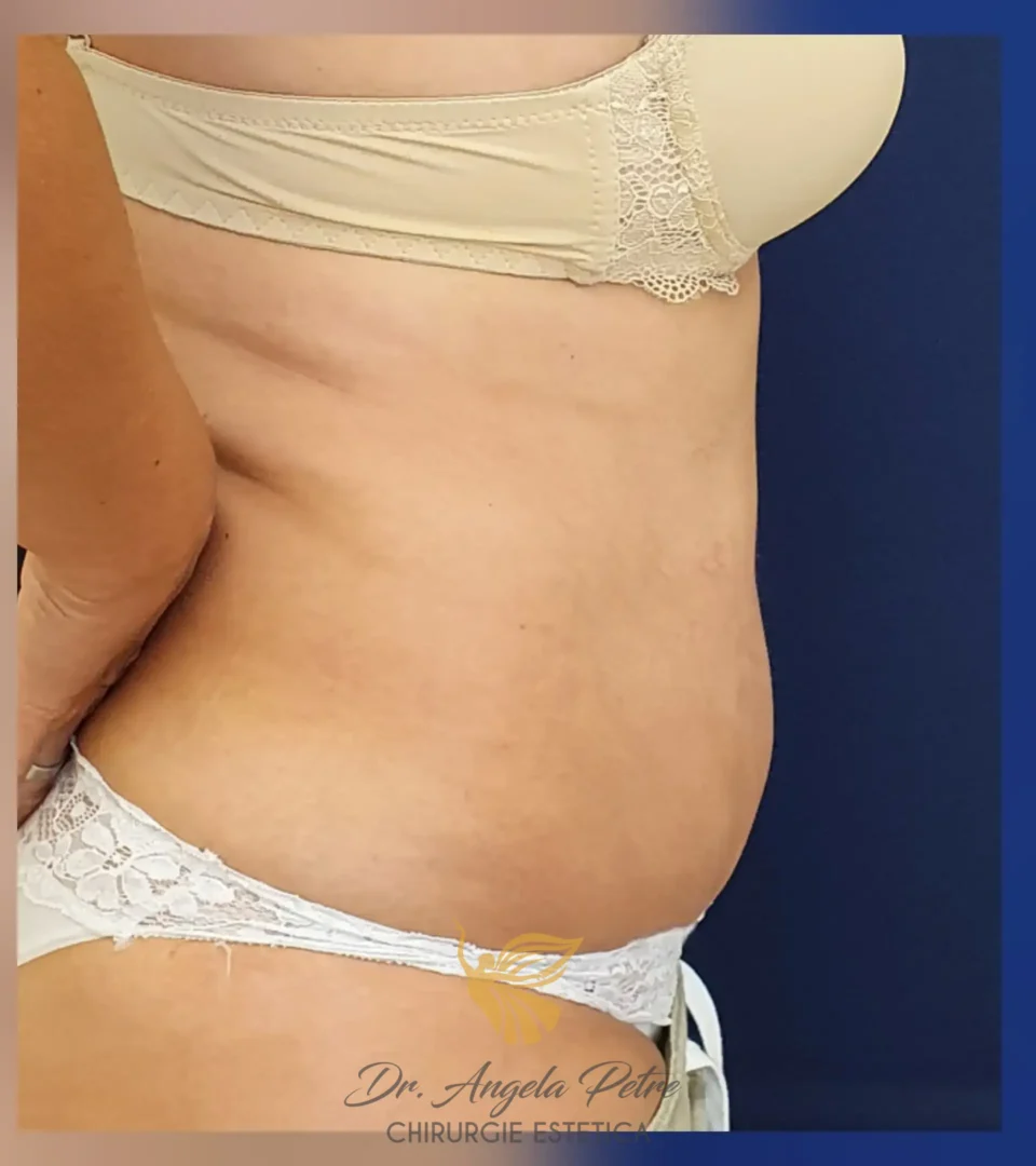 Caz 06 Abdominoplastie, profil, after, Dr. Angela Petre - București