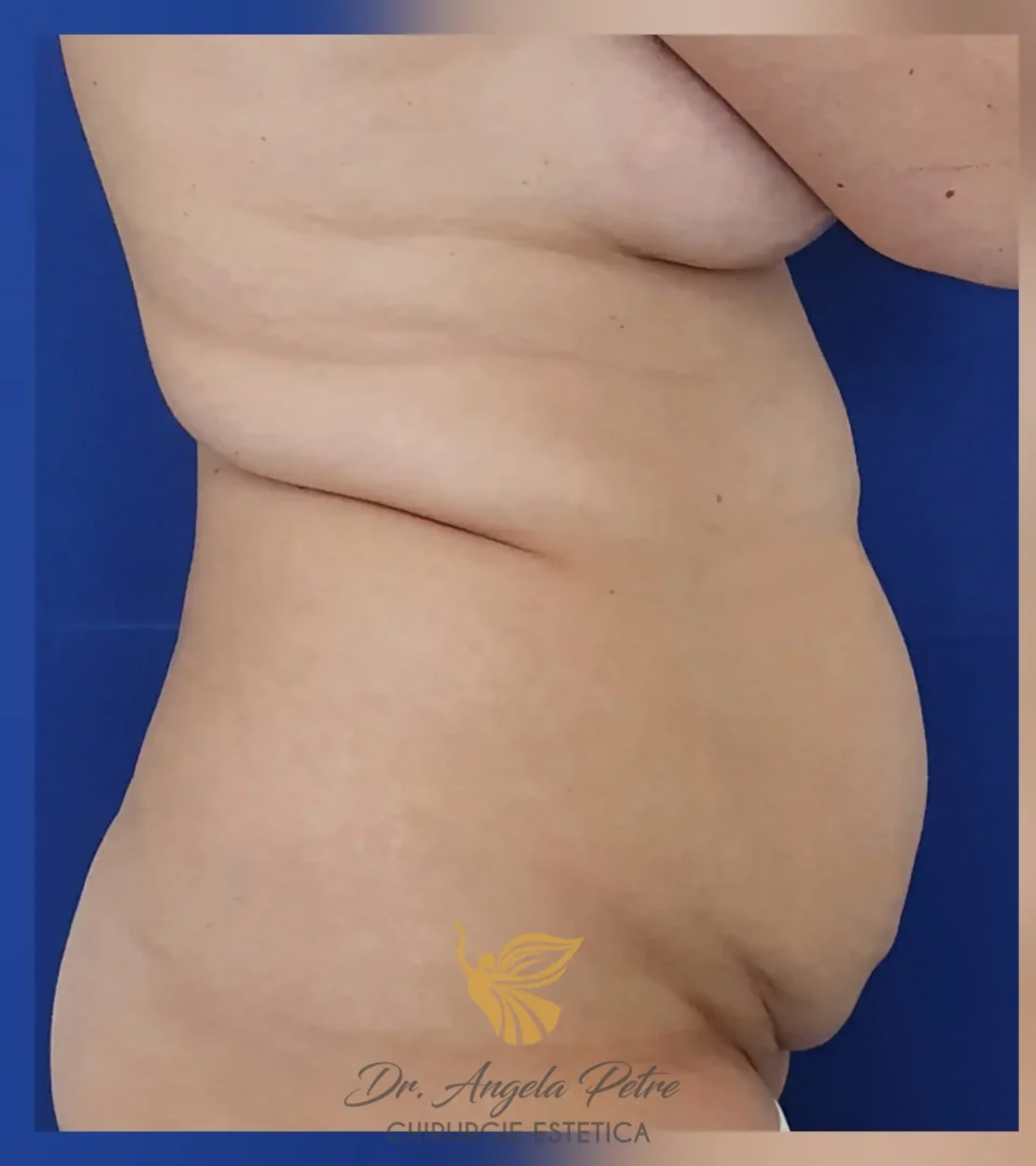 Caz 06 Abdominoplastie, profil, before, Dr. Angela Petre - București