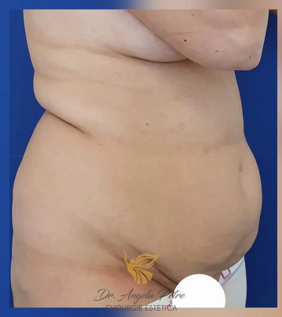 Caz 06 Abdominoplastie, semiprofil, before, Dr. Angela Petre - București