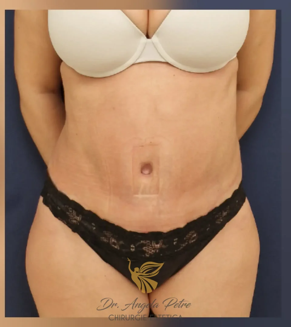 Caz 07 Abdominoplastie, frontal, after, Dr. Angela Petre - București