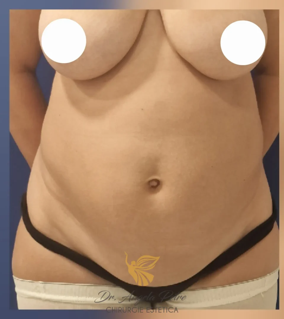 Caz 07 Abdominoplastie, frontal, before, Dr. Angela Petre - București