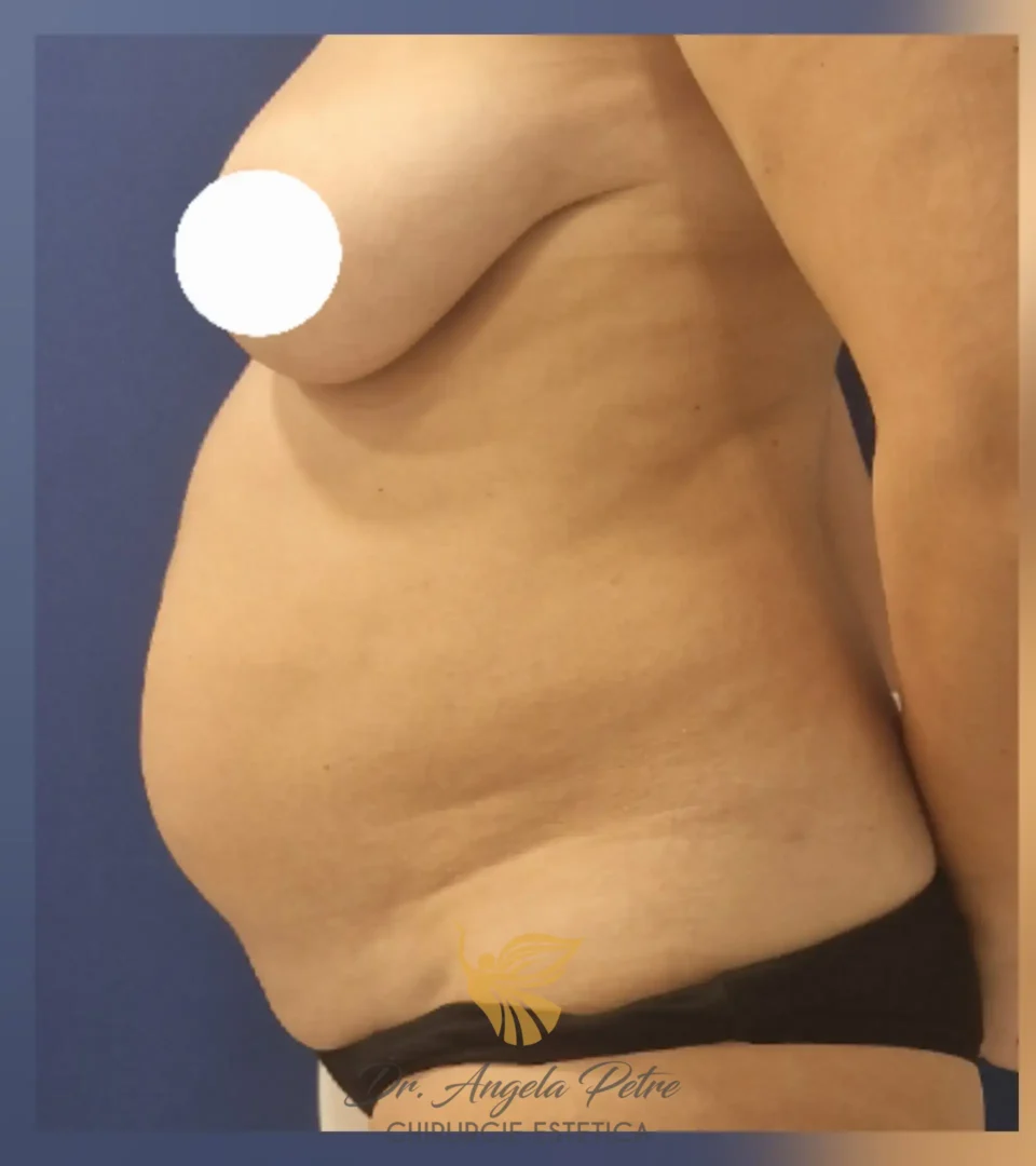 Caz 07 Abdominoplastie, profil, before, Dr. Angela Petre - București