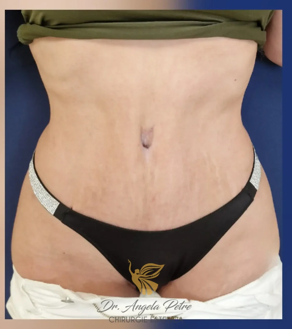 Caz 08 Abdominoplastie, frontal, after, Dr. Angela Petre - București