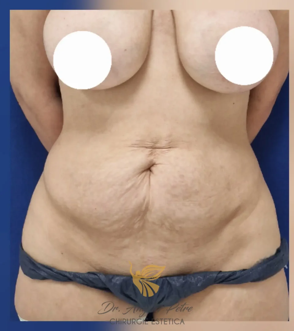 Caz 08 Abdominoplastie, frontal, before, Dr. Angela Petre - București