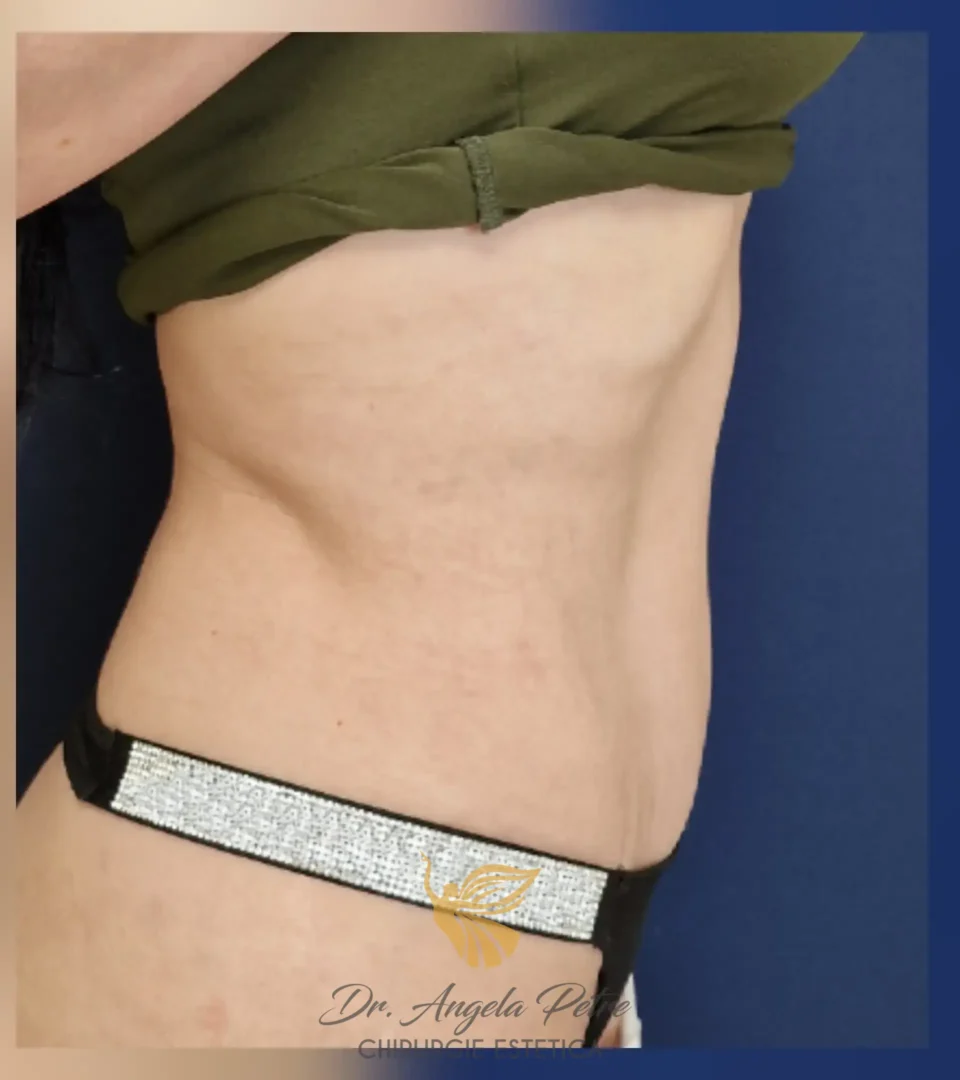 Caz 08 Abdominoplastie, profil, after, Dr. Angela Petre - București