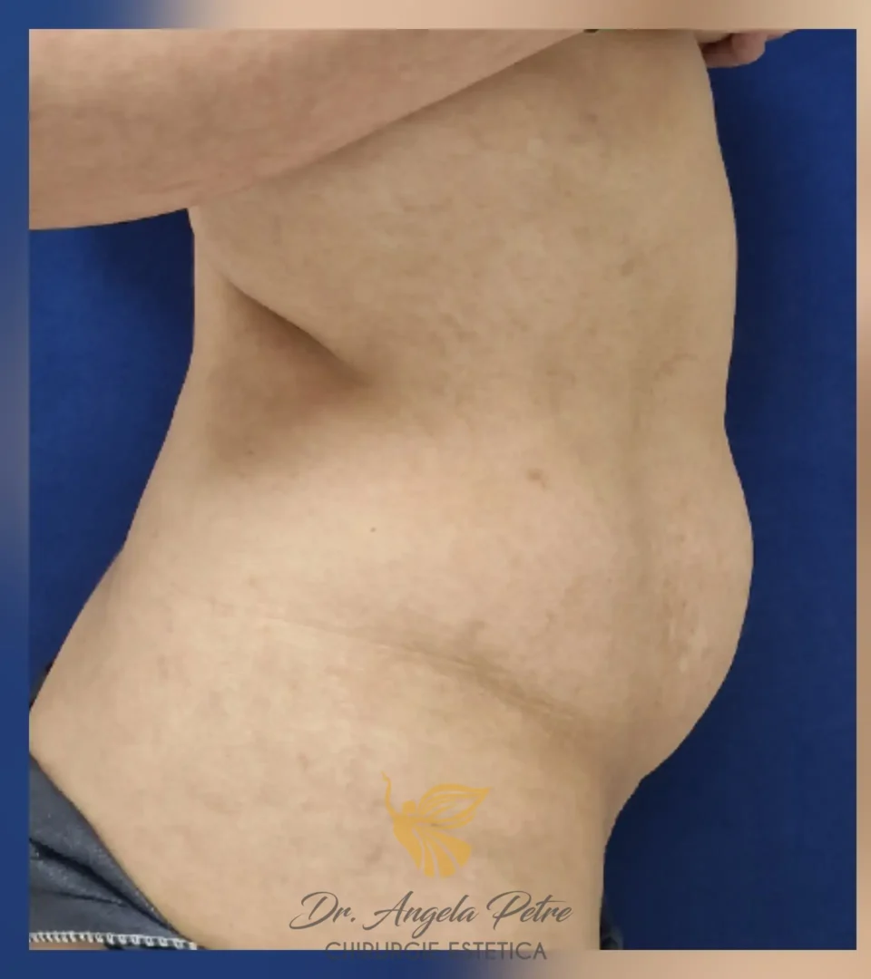 Caz 08 Abdominoplastie, profil, before, Dr. Angela Petre - București