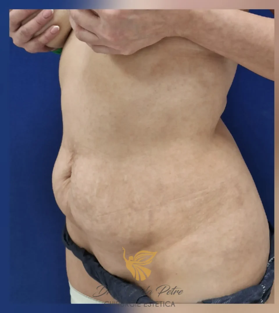 Caz 08 Abdominoplastie, semiprofil, before, Dr. Angela Petre - București