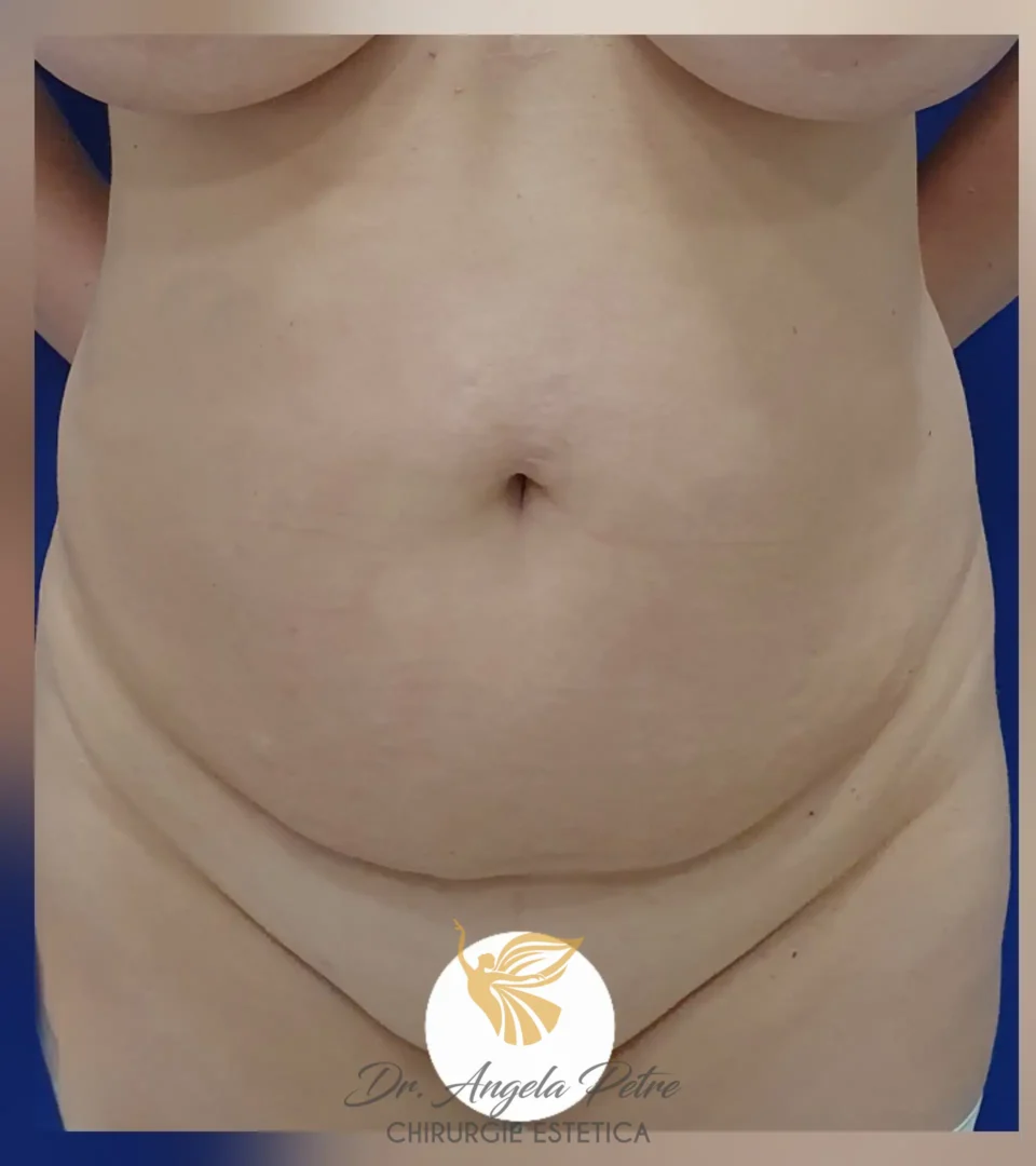Caz 09 Abdominoplastie, frontal, before, Dr. Angela Petre - București