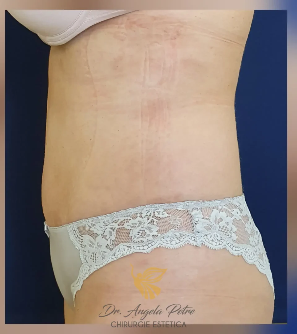 Caz 09 Abdominoplastie, profil, after, Dr. Angela Petre - București