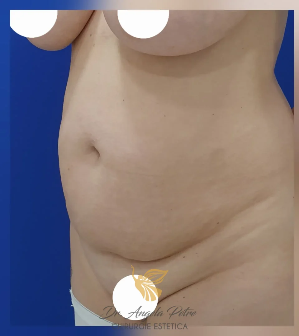 Caz 09 Abdominoplastie, semiprofil, before, Dr. Angela Petre - București