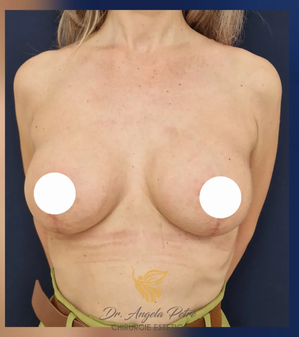 Caz 10 Mastopexie (ridicare sâni lăsați), frontal, after, Dr. Angela Petre - București