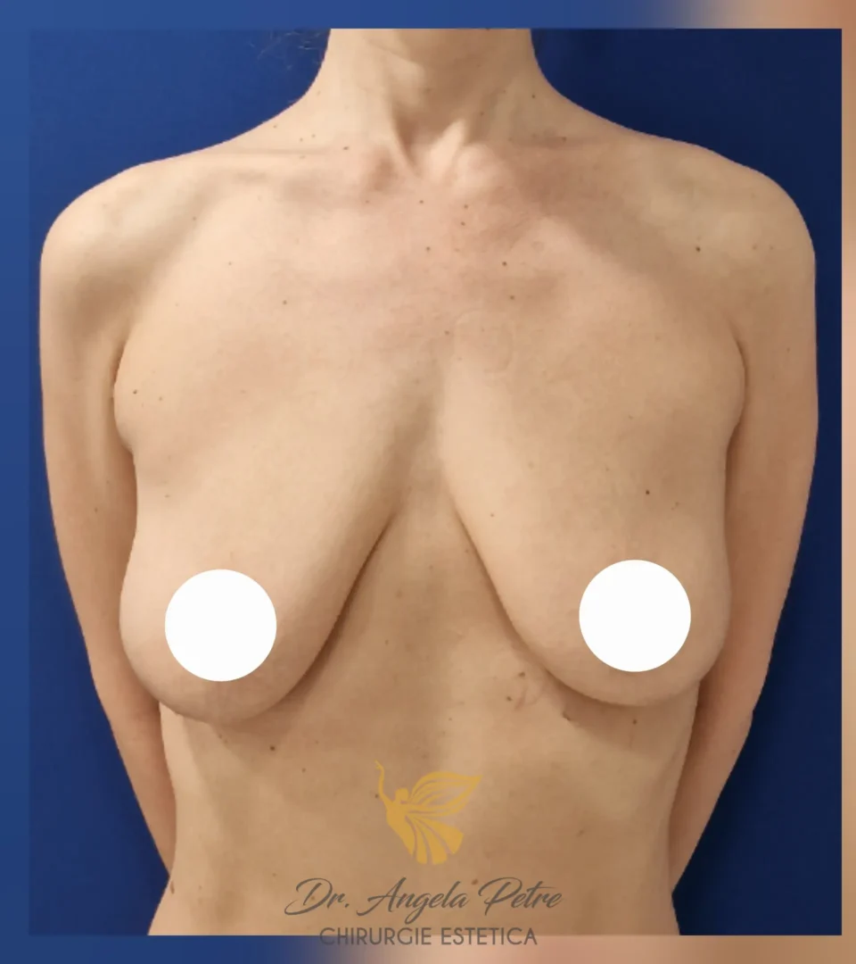 Caz 10 Mastopexie (ridicare sâni lăsați), frontal, before, Dr. Angela Petre - București