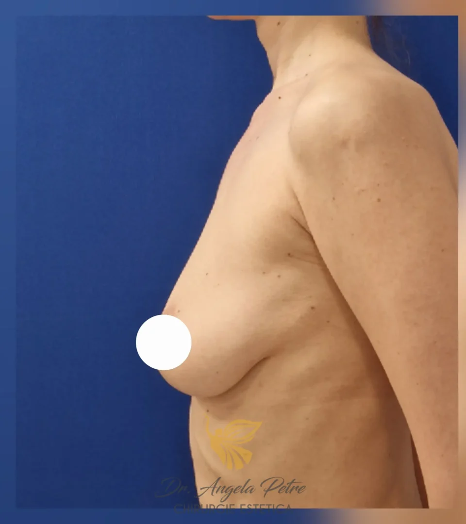 Caz 10 Mastopexie (ridicare sâni lăsați), profil, before, Dr. Angela Petre - București