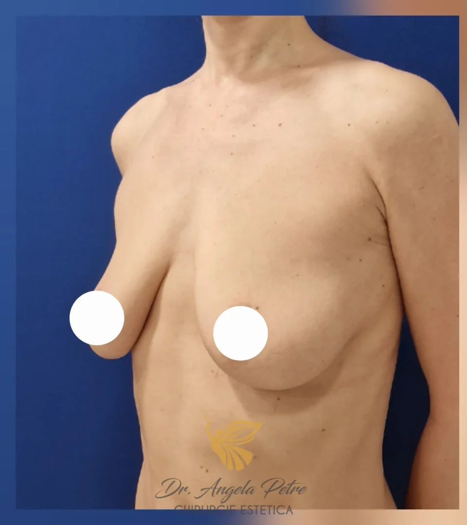 Caz 10 Mastopexie (ridicare sâni lăsați), semiprofil, before, Dr. Angela Petre - București