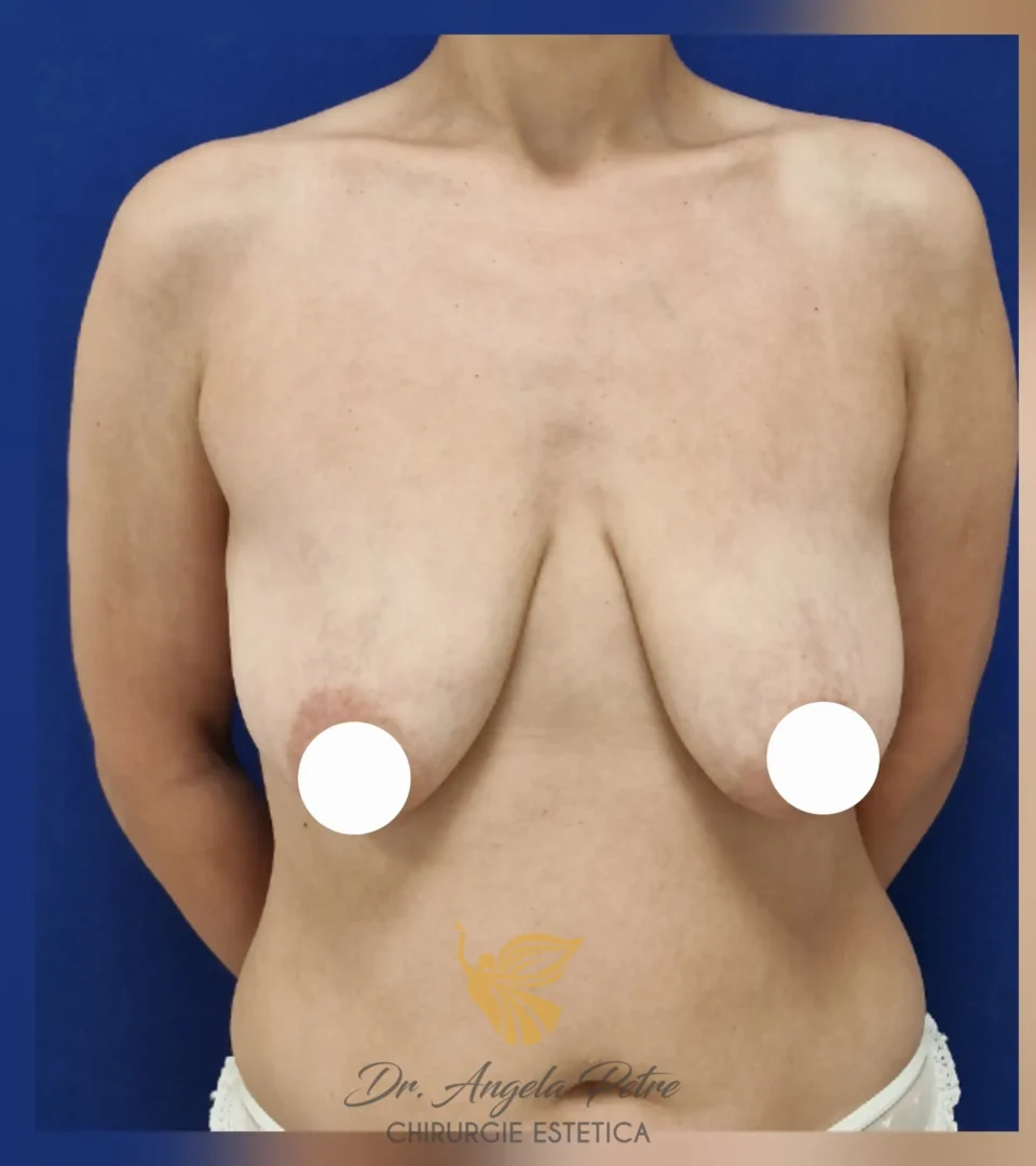 Caz 11 Mastopexie (ridicare sâni lăsați), frontal, before, Dr. Angela Petre - București