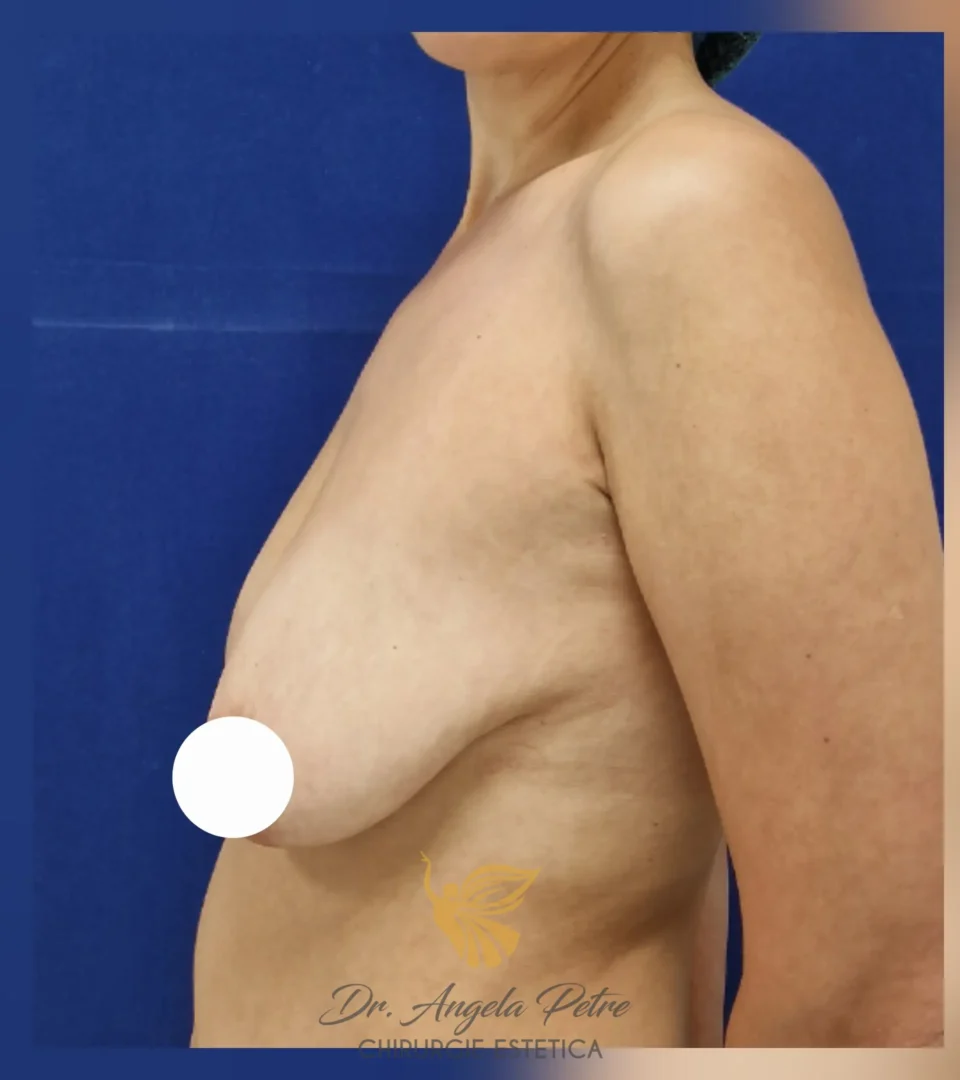 Caz 11 Mastopexie (ridicare sâni lăsați), profil, before, Dr. Angela Petre - București