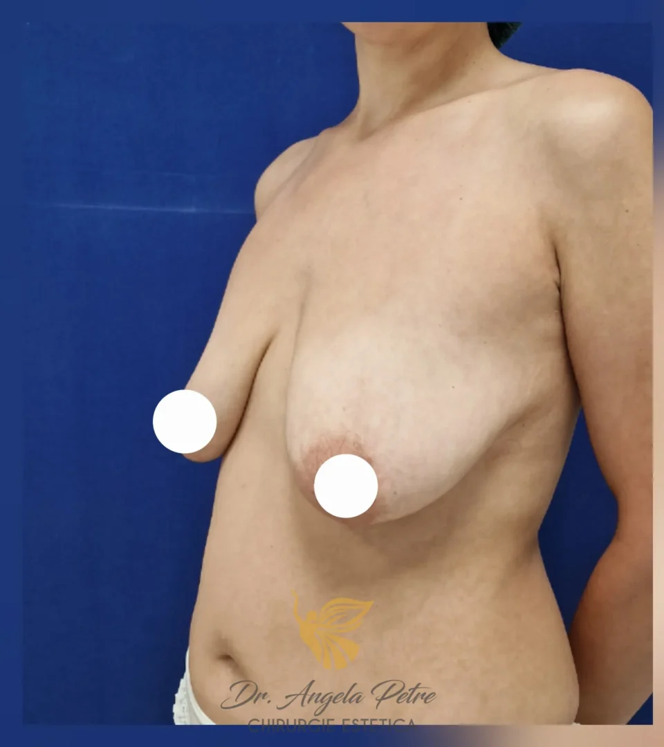 Caz 11 Mastopexie (ridicare sâni lăsați), semiprofil, before, Dr. Angela Petre - București