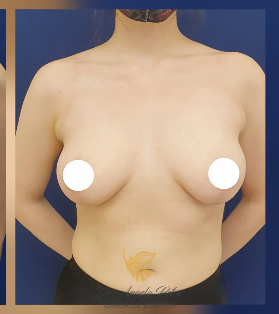 Caz 12 Mastopexie (ridicare sâni lăsați), frontal, after, Dr. Angela Petre - București