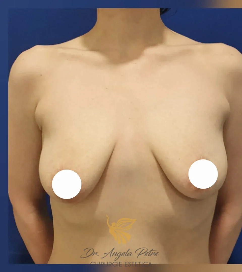 Caz 12 Mastopexie (ridicare sâni lăsați), frontal, before, Dr. Angela Petre - București
