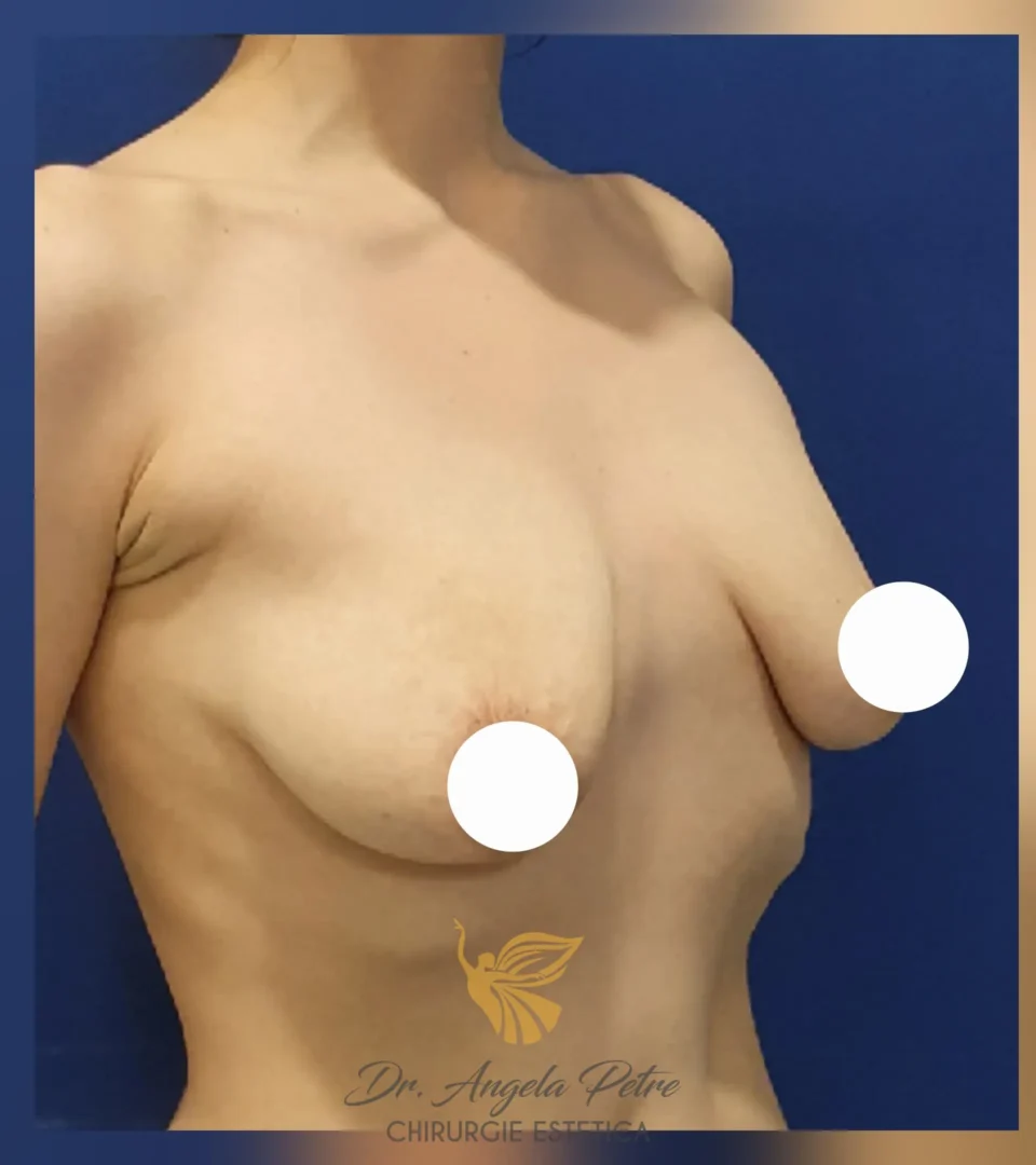 Caz 12 Mastopexie (ridicare sâni lăsați), semiprofil, before, Dr. Angela Petre - București