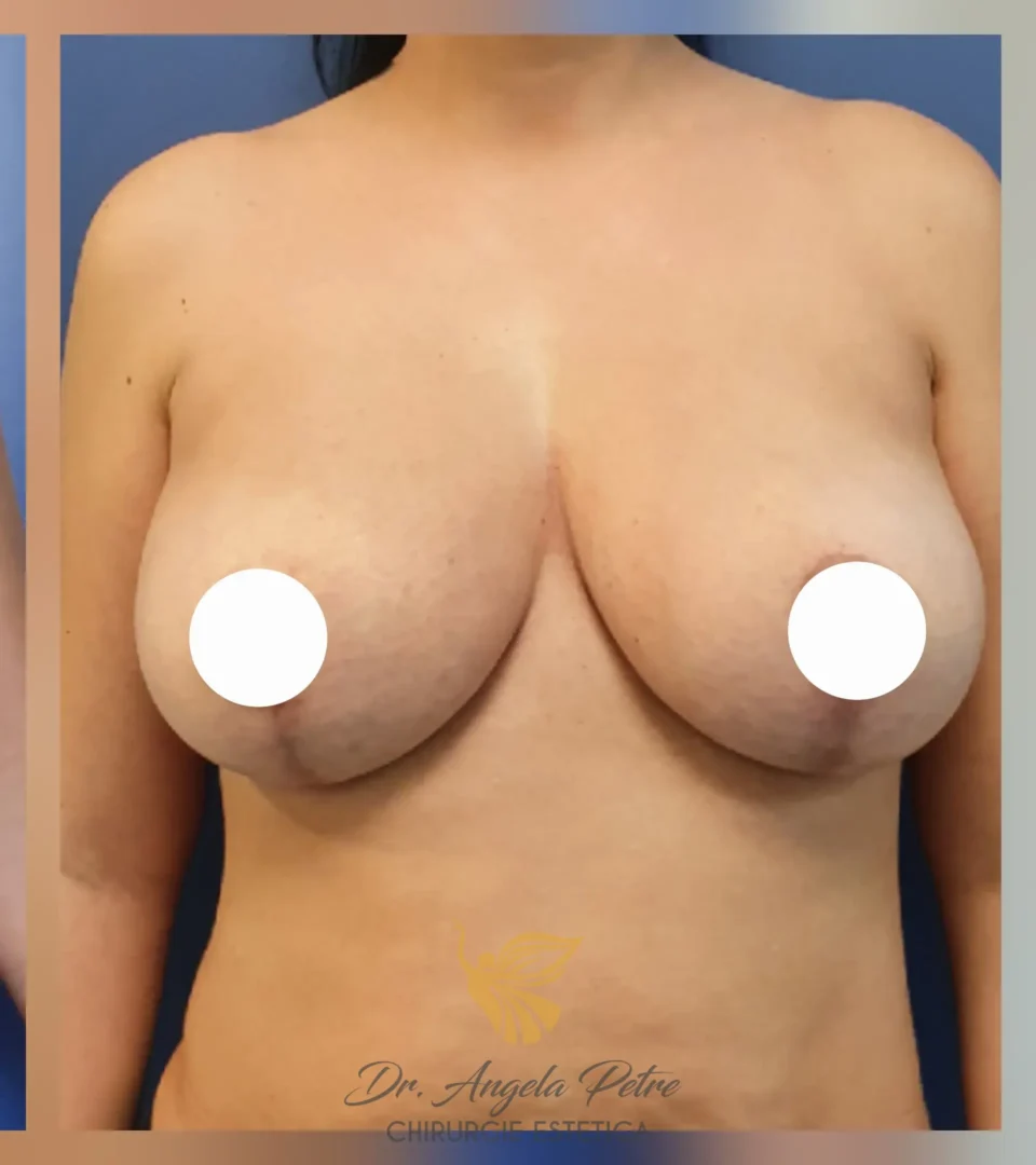 Caz 13 Mastopexie (ridicare sâni lăsați), frontal, after, Dr. Angela Petre - București