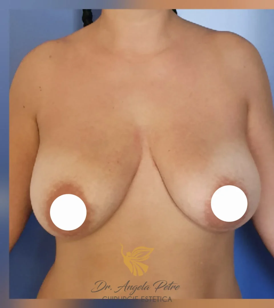 Caz 13 Mastopexie (ridicare sâni lăsați), frontal, before, Dr. Angela Petre - București