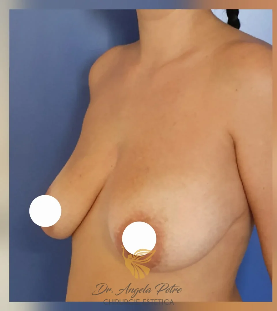 Caz 13 Mastopexie (ridicare sâni lăsați), semiprofil, before, Dr. Angela Petre - București