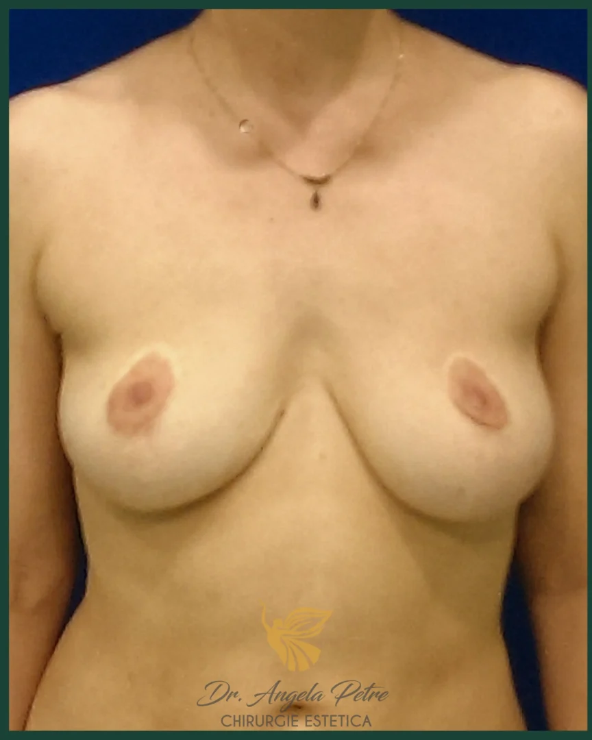 Caz 17 Mastopexie (ridicare sâni lăsați), frontal, before, Dr. Angela Petre - București