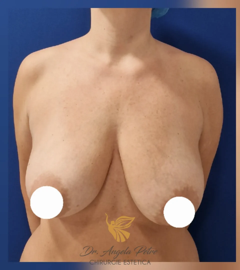 Caz 01 Mastopexie (ridicare sâni lăsați), frontal, before, Dr. Angela Petre - București