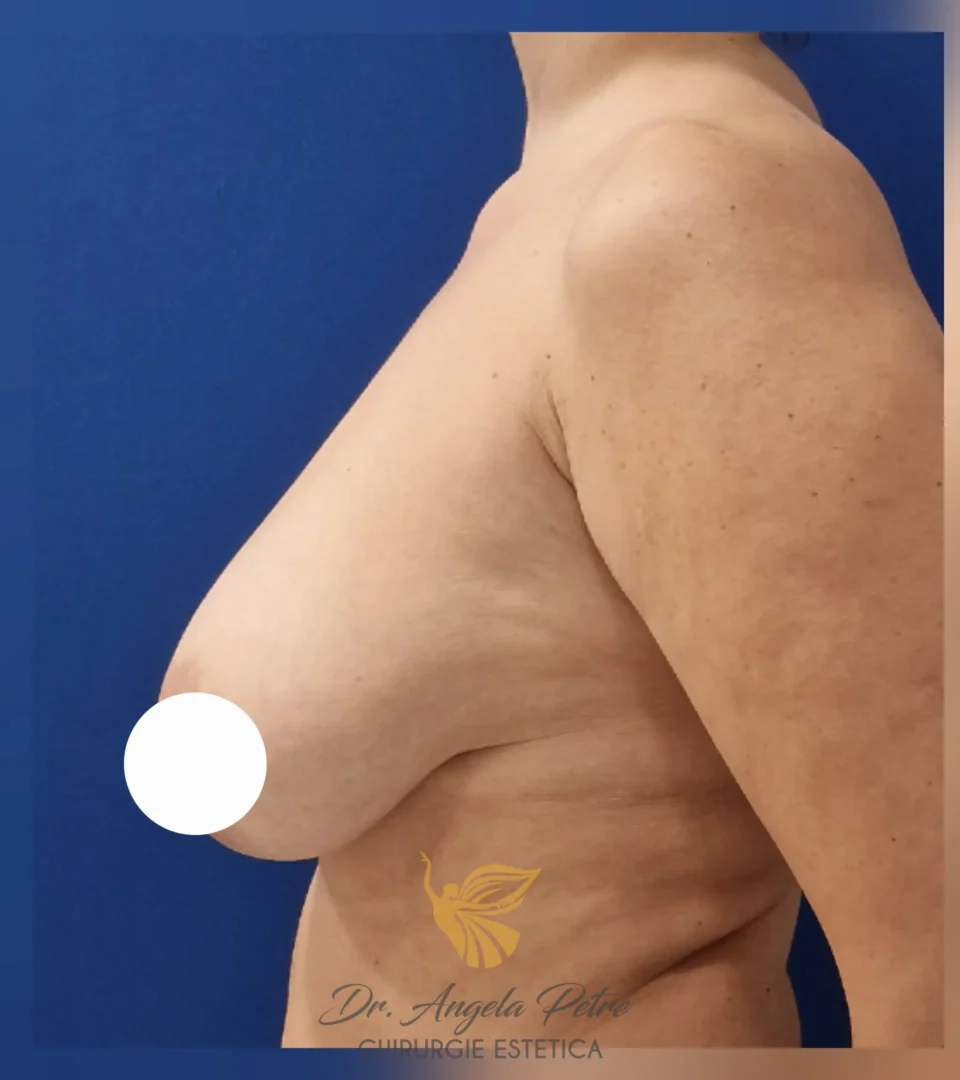 Caz 01 Mastopexie (ridicare sâni lăsați), profil, before, Dr. Angela Petre - București